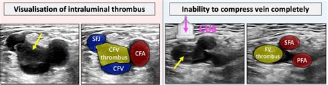 lsv compression test|DVT Ultrasound Made Easy: Step.